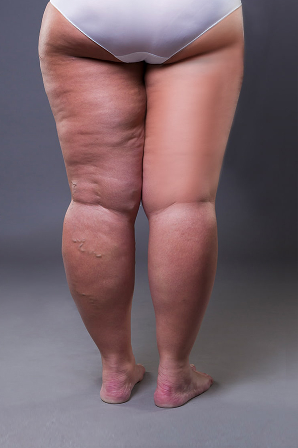 antes y despues del tratamiento de lipedema