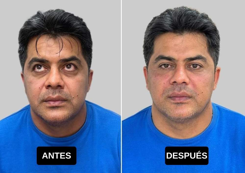 Full Face antes y despues en hombre