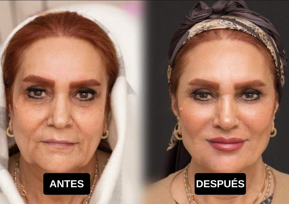 full face antes y despues en mujer mayor