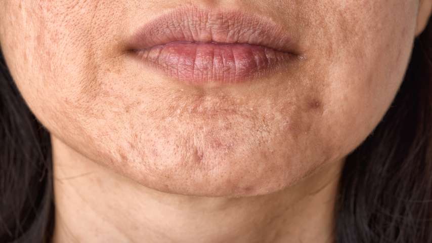 Tratamiento para cicatrices de acne