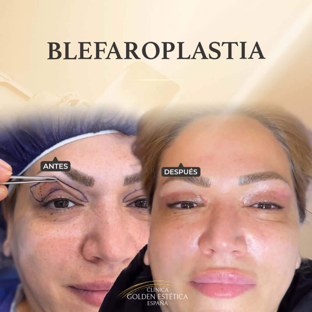 blefaroplastia en madrid