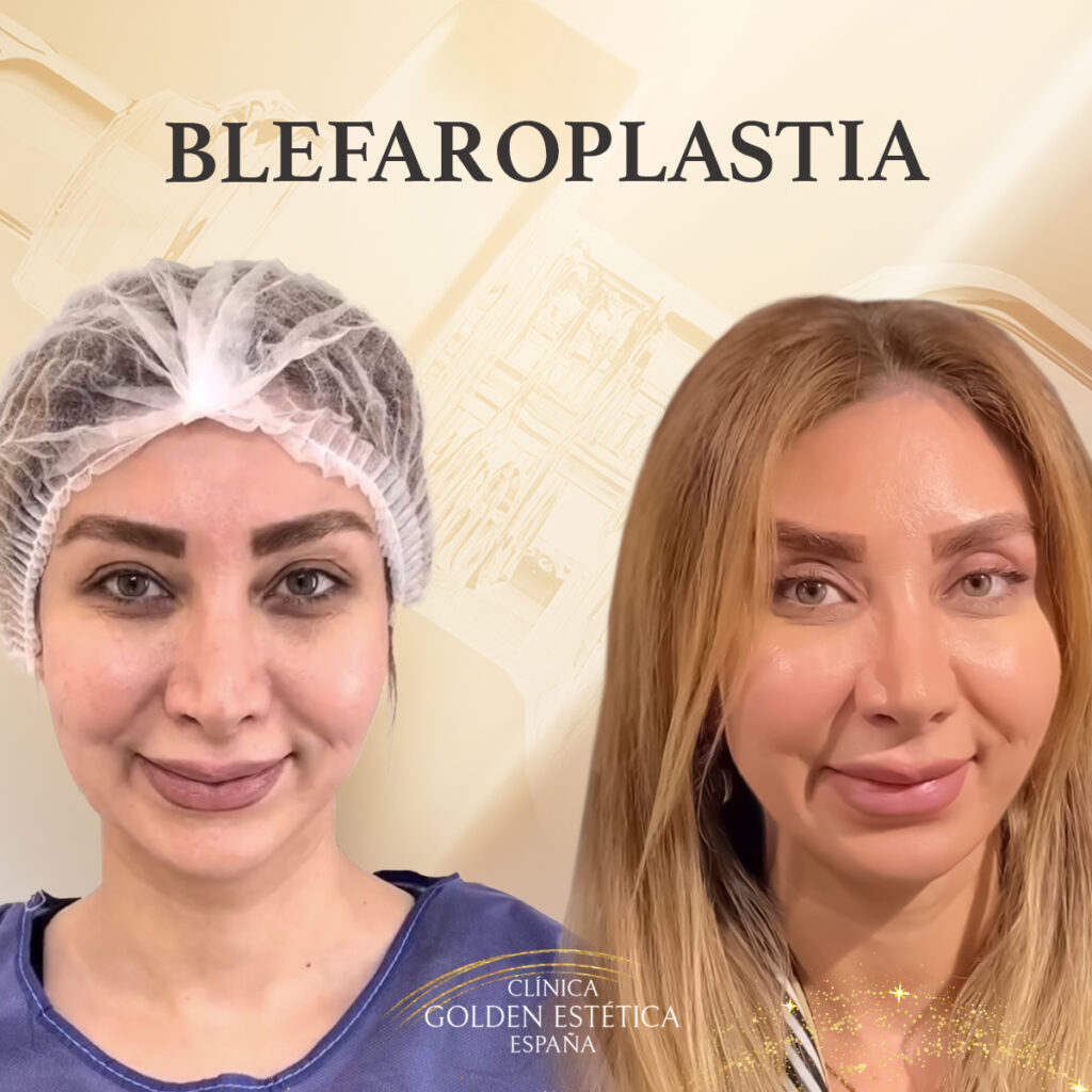 cirugia blefaroplastia