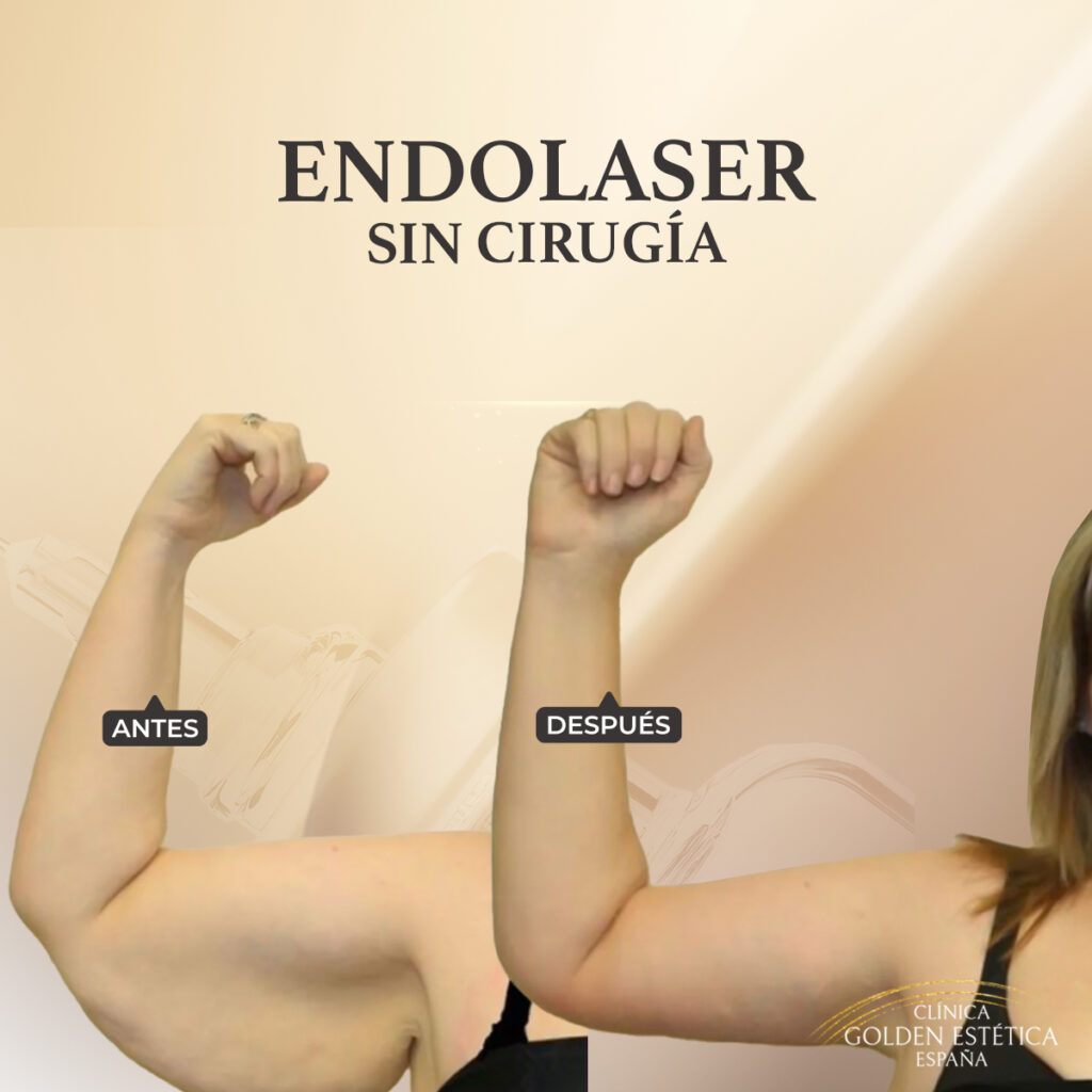 endolaser sin cirugia para brazos