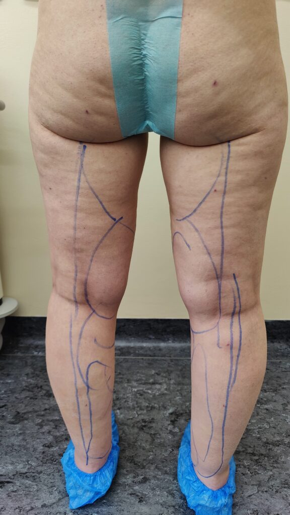 tratamiento de lipedema en perinas